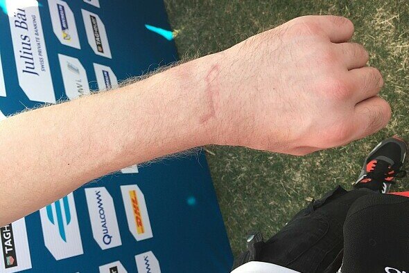 Die Narben an Nick Heidfelds Hand sind noch deutlich zu erkennen - Foto: Motorsport-Magazin.com